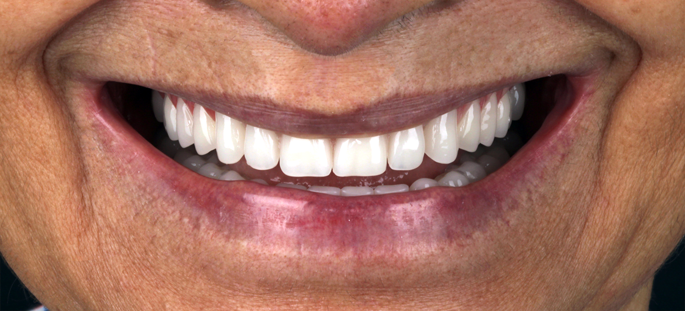 Sorriso após procedimento